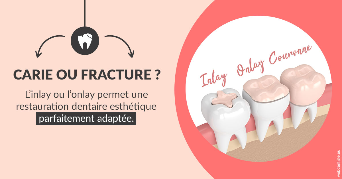 https://dr-olivier-godiveau.chirurgiens-dentistes.fr/T2 2023 - Carie ou fracture 2