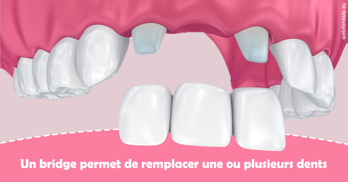 https://dr-olivier-godiveau.chirurgiens-dentistes.fr/Bridge remplacer dents 2
