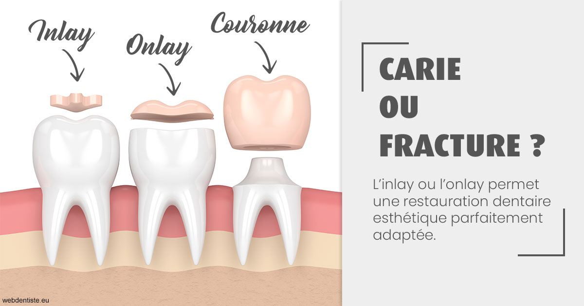 https://dr-olivier-godiveau.chirurgiens-dentistes.fr/T2 2023 - Carie ou fracture 1