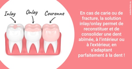 https://dr-olivier-godiveau.chirurgiens-dentistes.fr/L'INLAY ou l'ONLAY 2