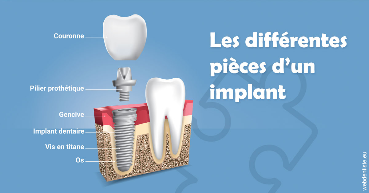 https://dr-olivier-godiveau.chirurgiens-dentistes.fr/Les différentes pièces d’un implant 1